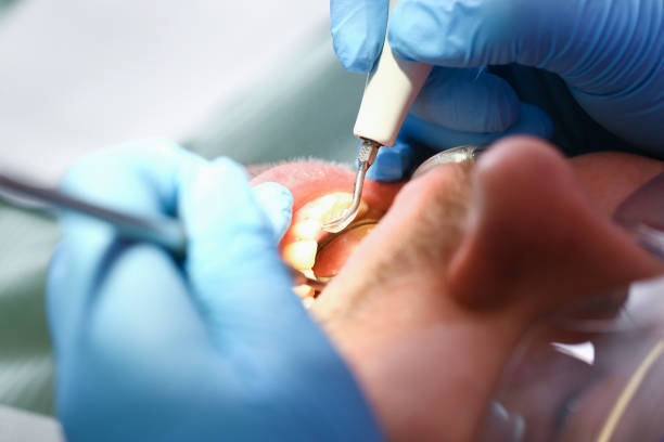 Best Emergency Root Canal Treatment in Washington, MO